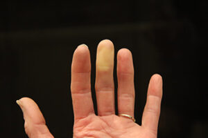 Tratamiento Síndrome Raynaud con Biofeedback