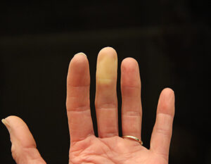 Tratamiento Síndrome Raynaud con Biofeedback